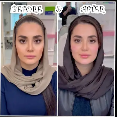 عکس های قبل و بعد تزریق فیس فریم متد