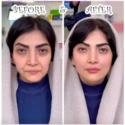 عکس های قبل و بعد تزریق فیس فریم متد