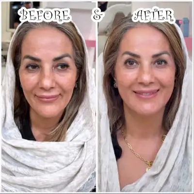 عکس های قبل و بعد تزریق فیس فریم متد