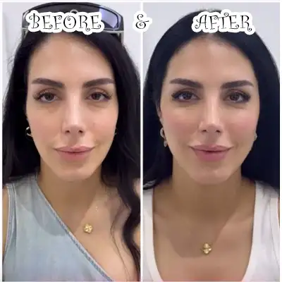 عکس های قبل و بعد تزریق فیس فریم متد