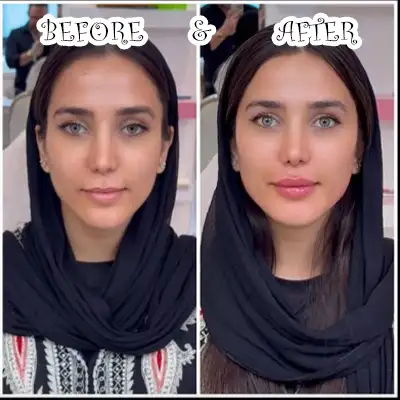 عکس های قبل و بعد تزریق فیس فریم متد