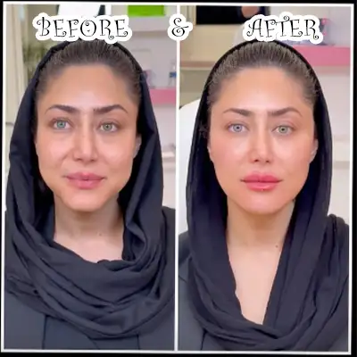 عکس های قبل و بعد تزریق فیس فریم متد