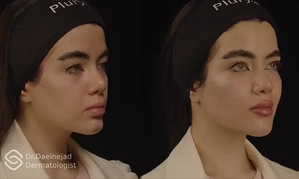 عکس قبل و بعد تزریق فیلر فیس فریم متد