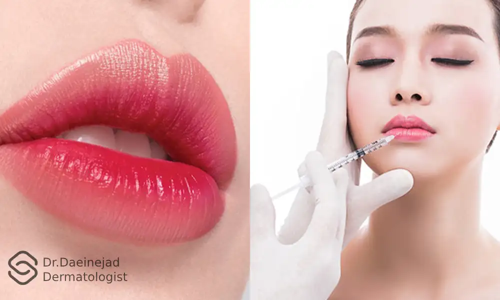 تزریق مدل ژل لب عروسکی