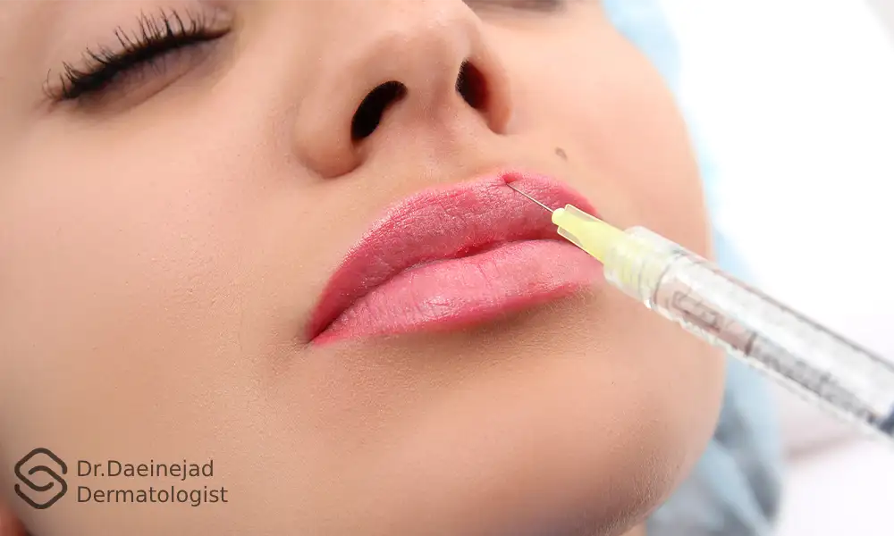 عکس فیلر لب لالایی | ماندگاری ژل لب