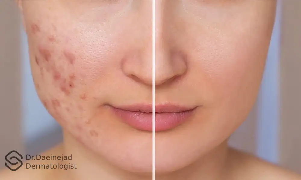 عکس قبل و بعد جای جوش صورت یک خانم