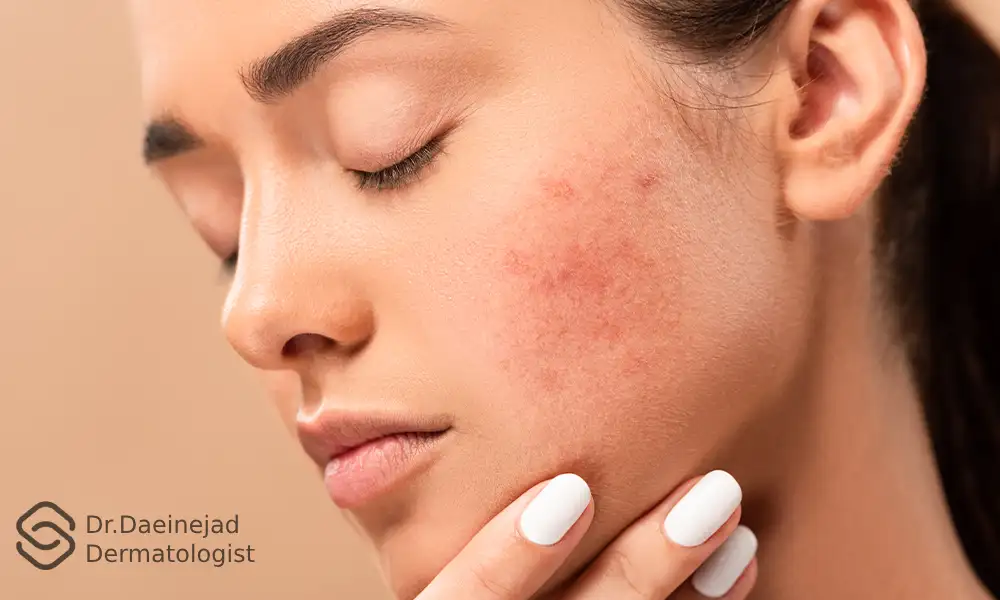 باقی ماندن جای جوش روی گونه سمت چپ یک خانم