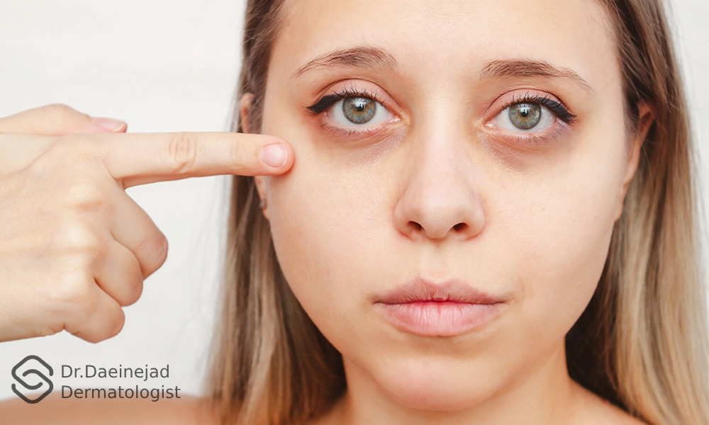 عکس قبل از برطرف کردن سیاهی دور چشم