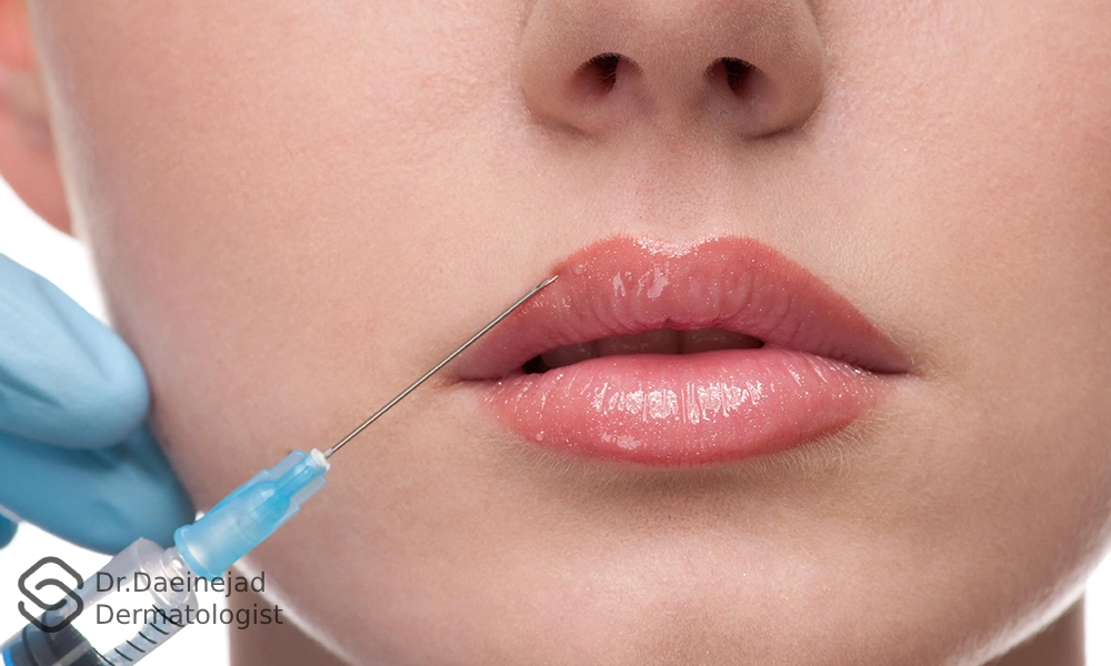 تزریق ژل لب نچرال