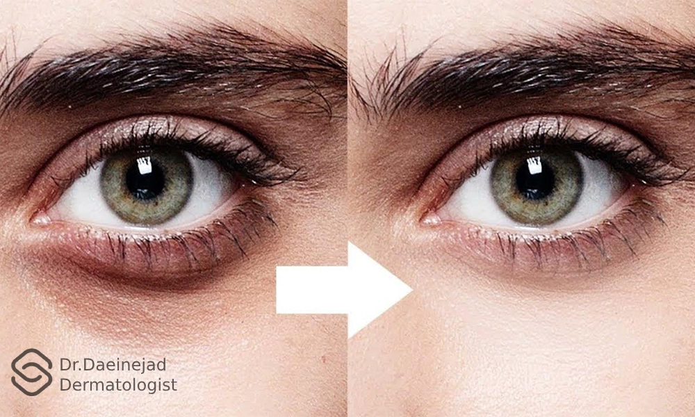 عکس قبل و بعد برطرف کردن سیاهی دور چشم