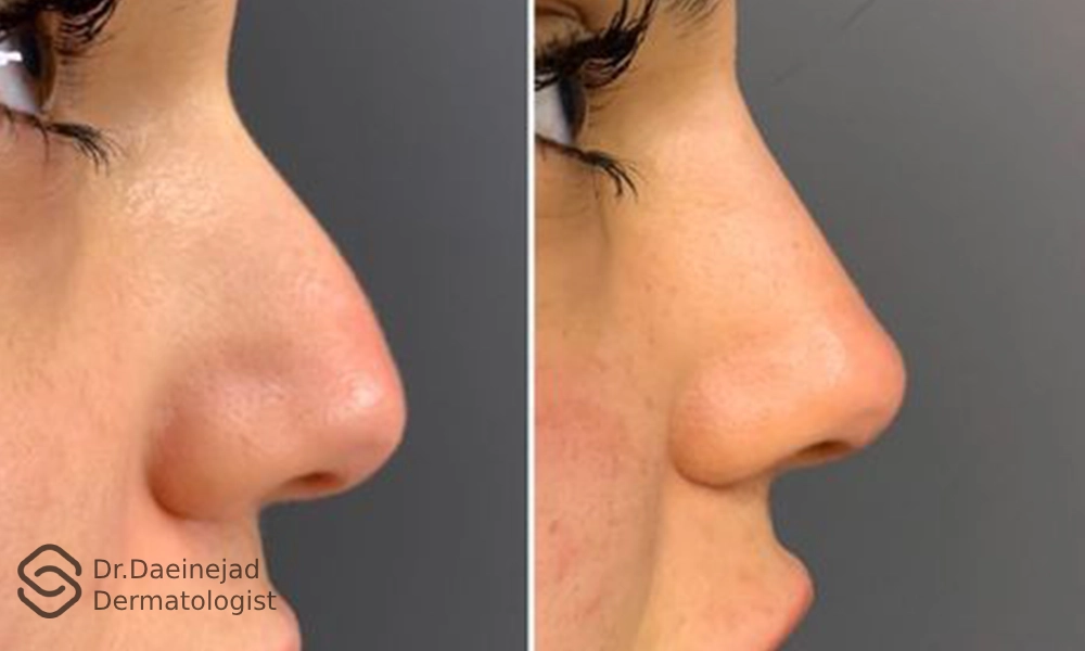 عکس قبل و بعد تزریق فیلر بینی